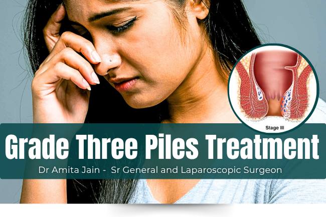 Dr Amita Jain Treatment for Grade Three Piles or Internal Hemorrhoid